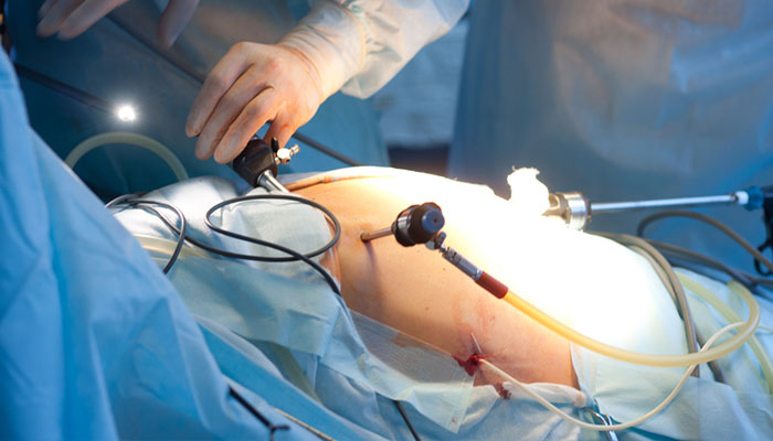 laparoskopi kimlere uygulanır